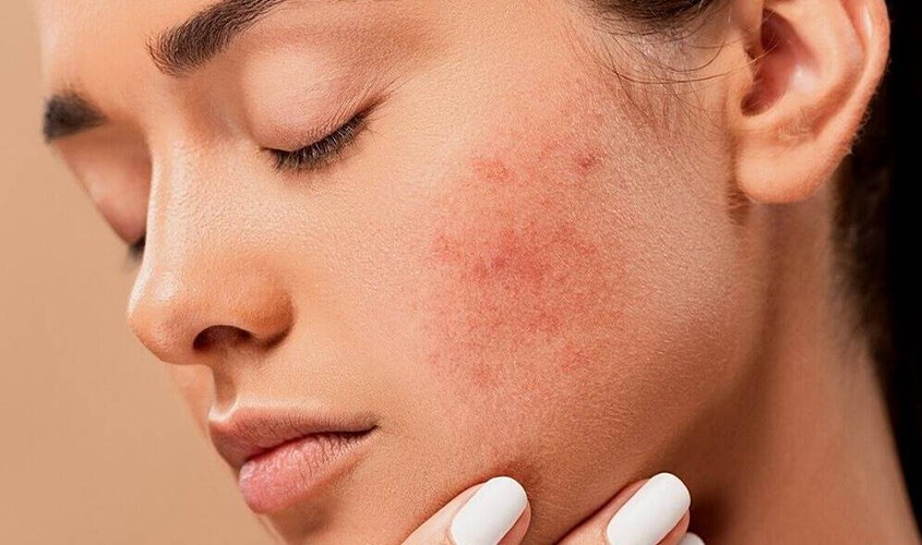 Nguyên nhân và cách xử lý dị ứng khi sử dụng kem chống nắng